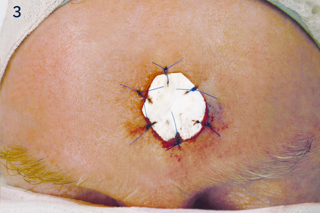 Geistlich_Hautchirurgie_Mucograft_Extraoral