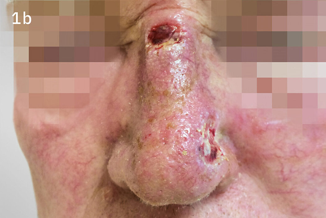 Geistlich_Hautchirurgie_Mucograft_Extraoral
