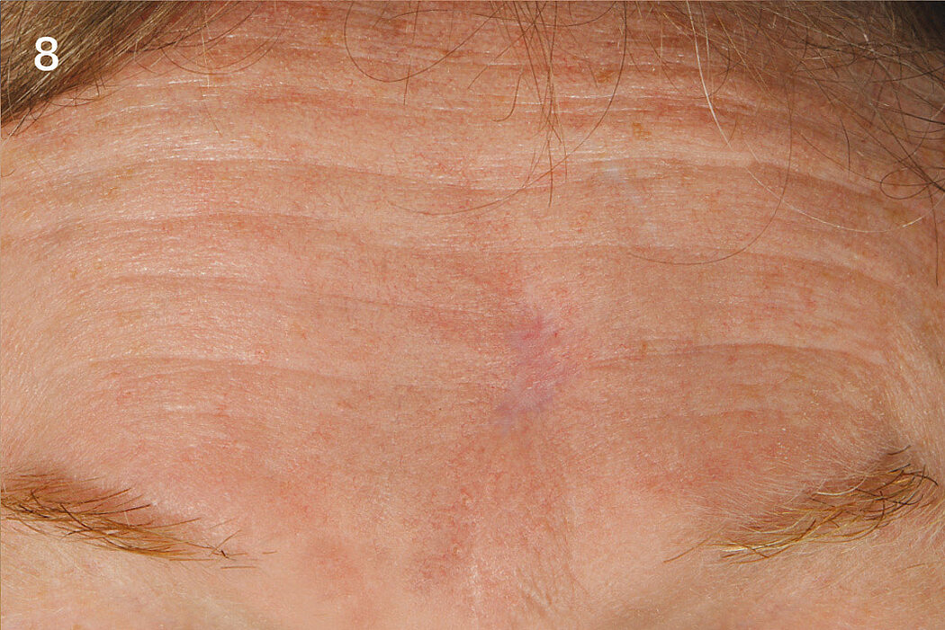 Geistlich_Hautchirurgie_Mucograft_Extraoral