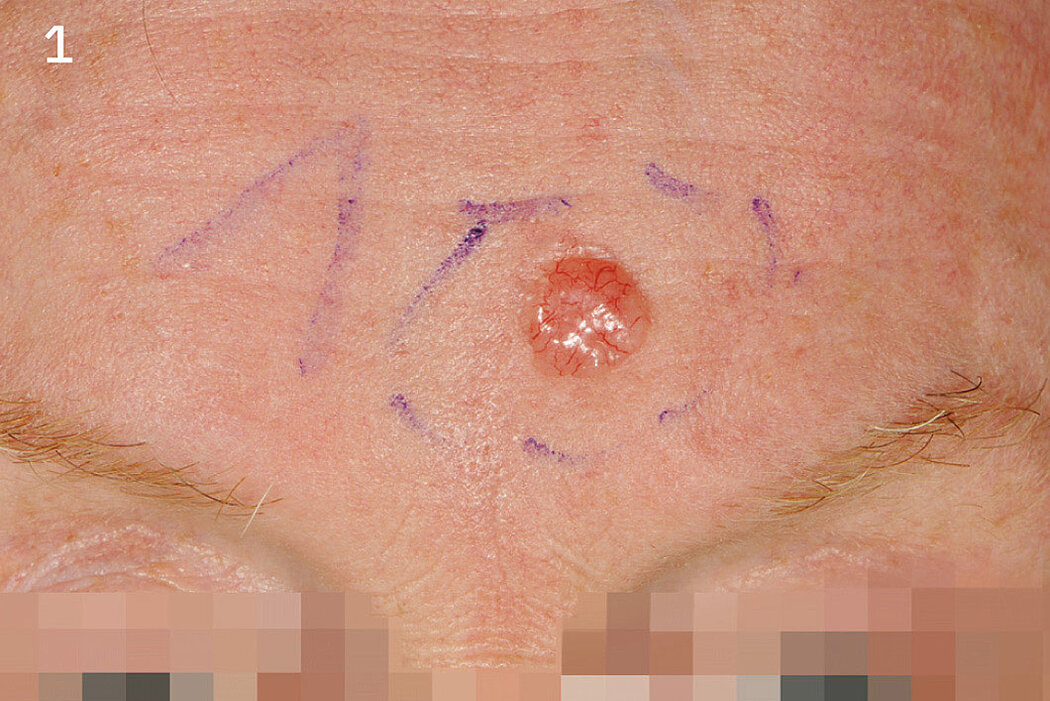 Geistlich_Hautchirurgie_Mucograft_Extraoral
