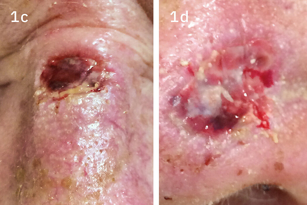 Geistlich_Hautchirurgie_Mucograft_Extraoral