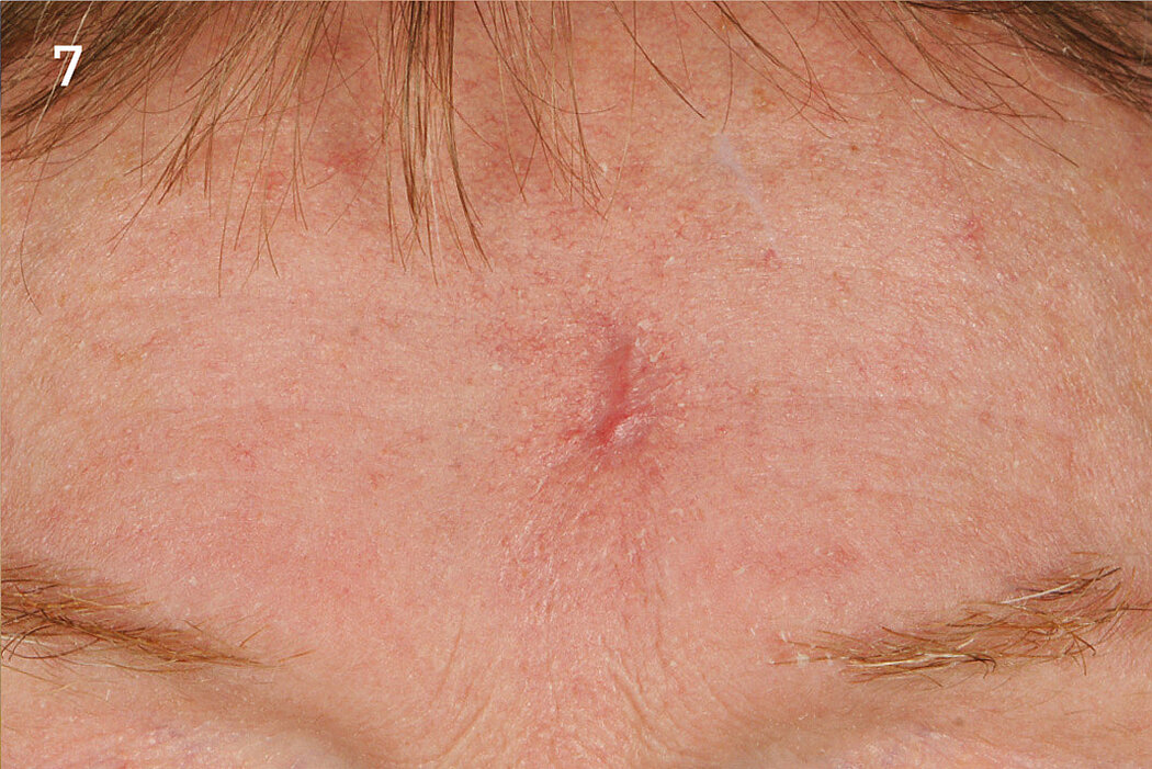 Geistlich_Hautchirurgie_Mucograft_Extraoral
