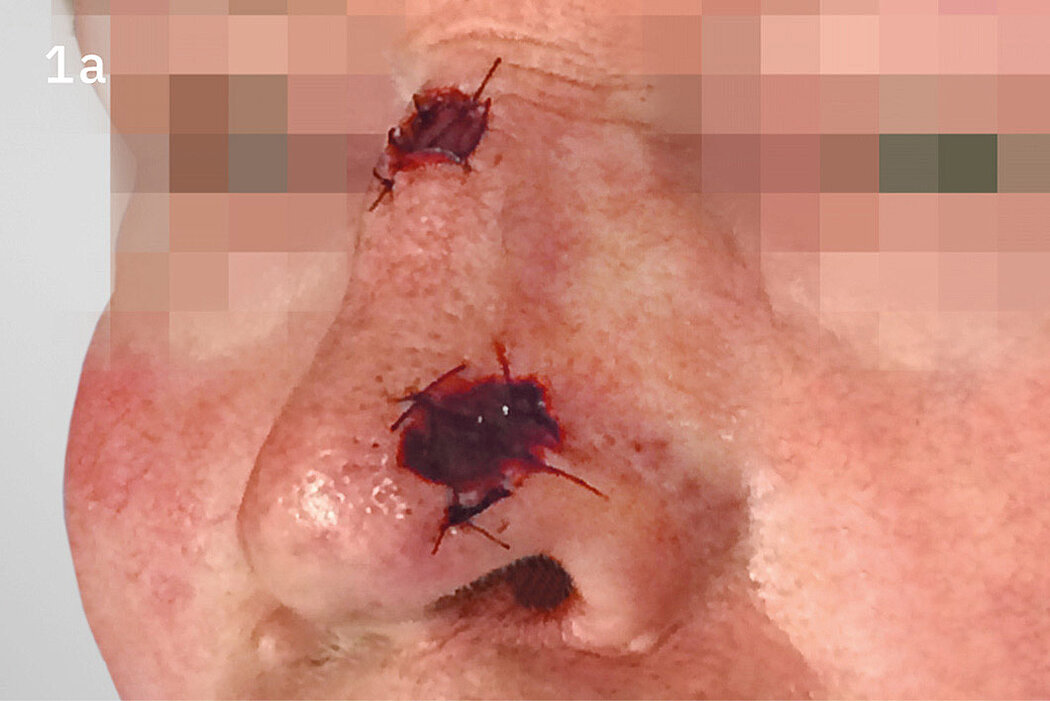 Geistlich_Hautchirurgie_Mucograft_Extraoral