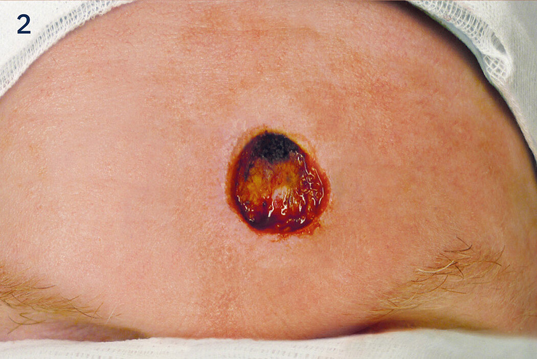 Geistlich_Hautchirurgie_Mucograft_Extraoral