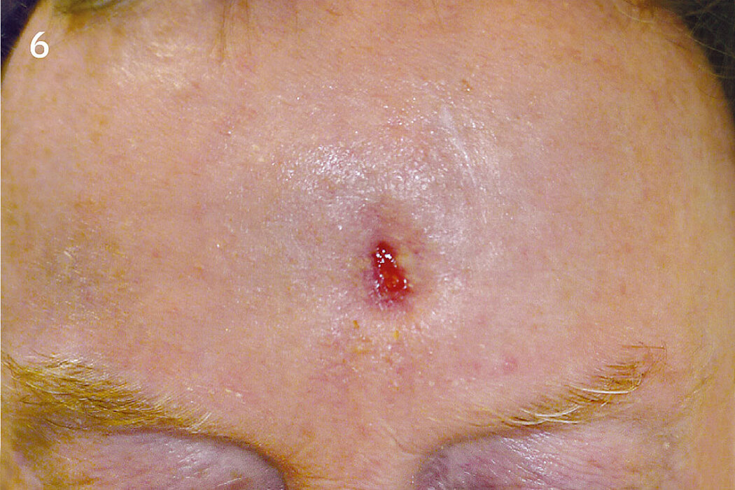 Geistlich_Hautchirurgie_Mucograft_Extraoral