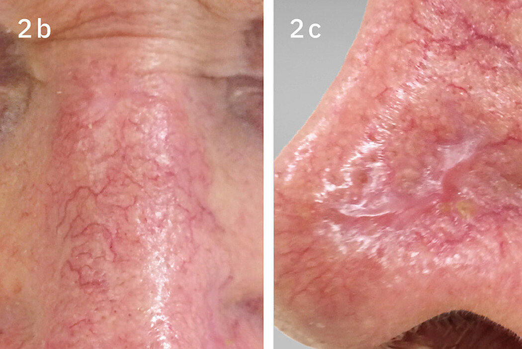 Geistlich_Hautchirurgie_Mucograft_Extraoral