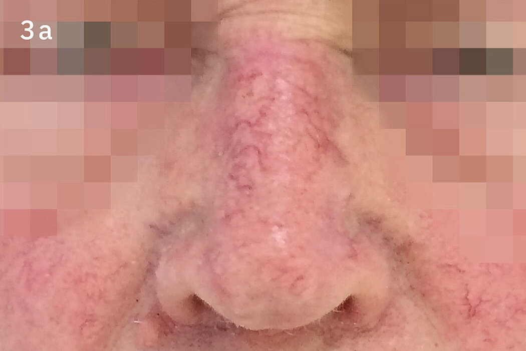 Geistlich_Hautchirurgie_Mucograft_Extraoral