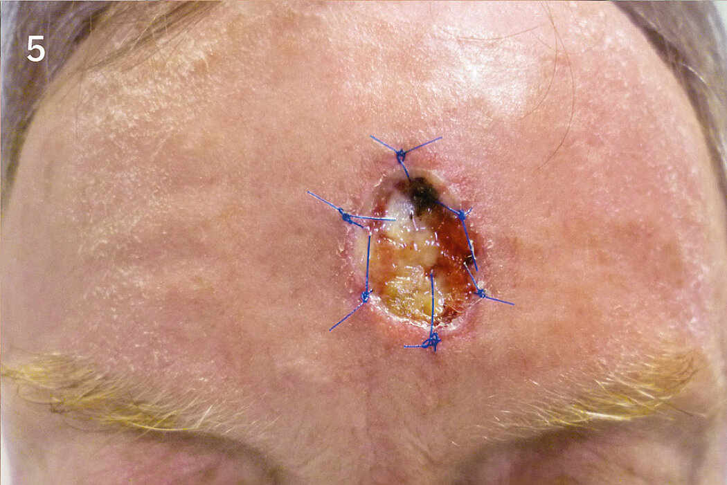 Geistlich_Hautchirurgie_Mucograft_Extraoral
