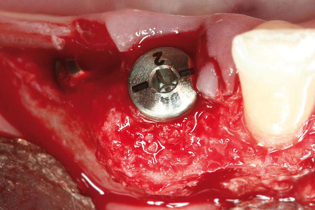 Sofortimplantation bei dünnen bukkalen Knochenlamellen