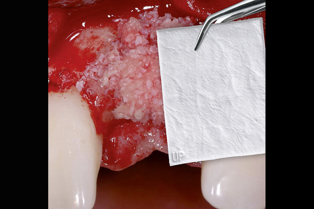 Kleine Knochenaugmentation 引导骨再生 (GBR, Guided Bone Regeneration) 的高预期性。(图片承蒙瑞士Dr. Ronald E. Jung提供)