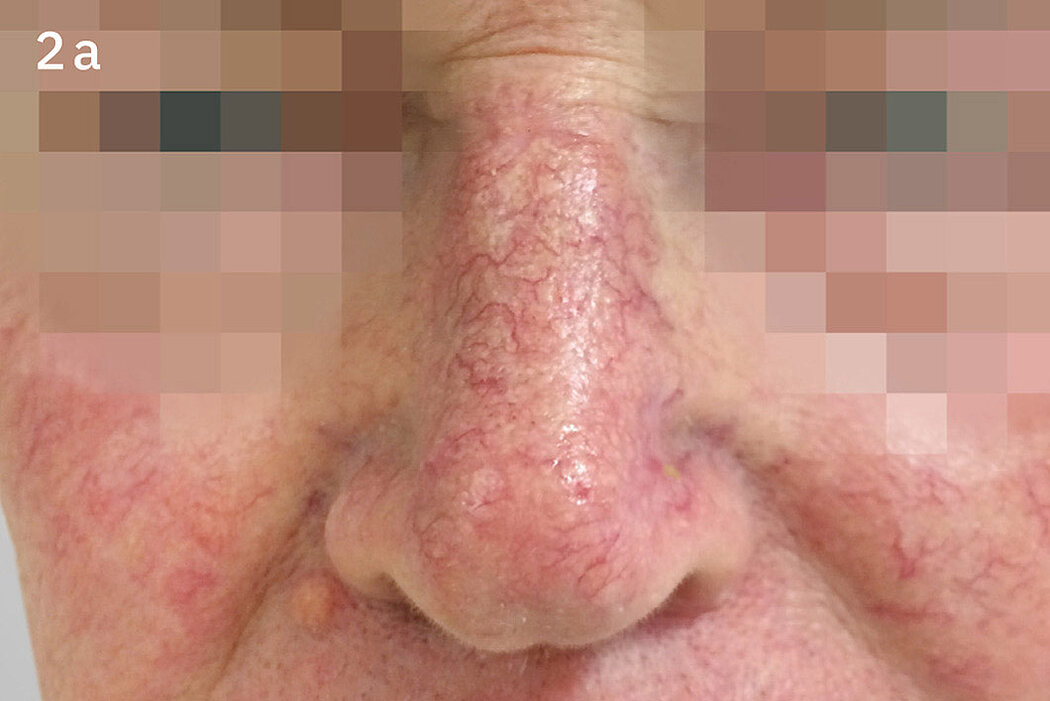 Geistlich_Hautchirurgie_Mucograft_Extraoral