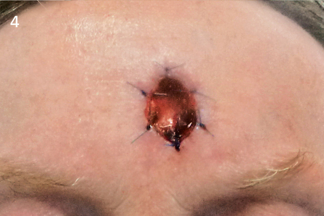 Geistlich_Hautchirurgie_Mucograft_Extraoral